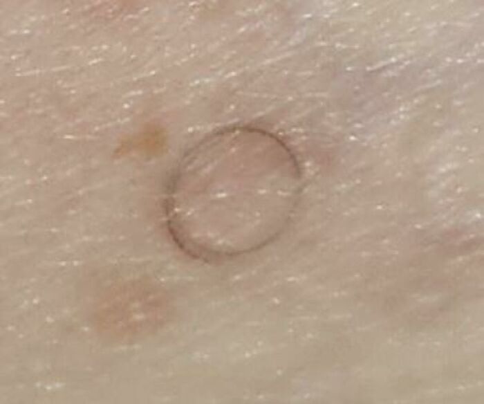I Have A Circular Ingrown Hair