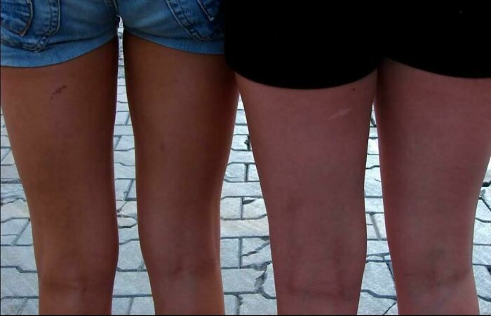 My Sister And I Have The Same Birth Mark, But Opposite