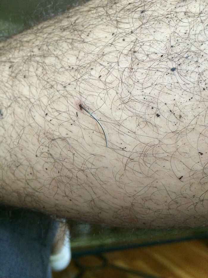 After A Day Of Work, I Sat Down And Noticed A Piece Of Wire Stuck Half An Inch In My Leg