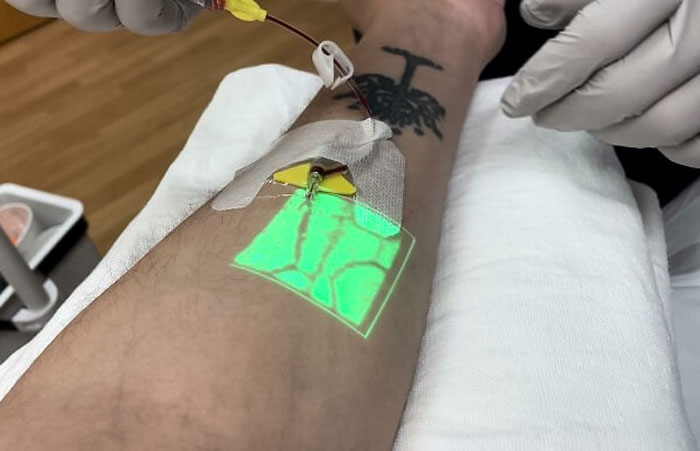 Today The Nurse Used An Infrared Vein Finder To Place An IV