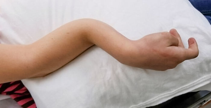 My Broken Arm From When I Was 11 Years Old. I Didn't Even Cry