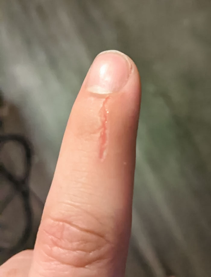 I Had One Of Those Little Pieces Of Skin And Pulled It