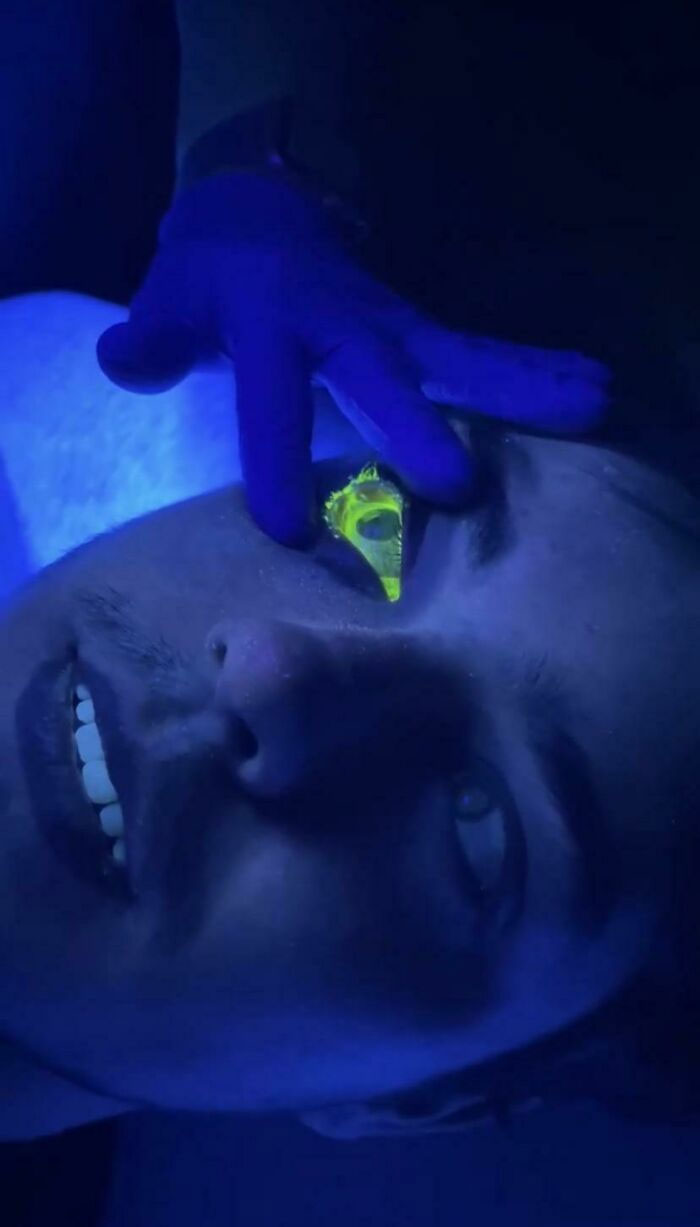 Got In A Wreck And Messed My Eye Up And Had To Do Some Sort Of Procedure And I Looked Pretty Cool