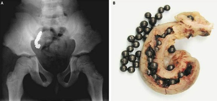 Pellets In The Appendix