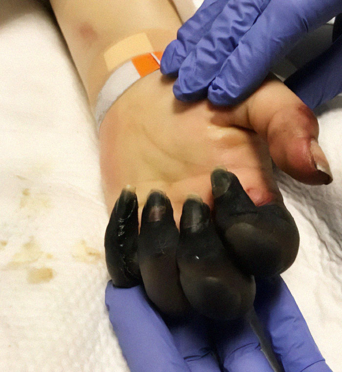 Paciente con endocarditis causada por una infección