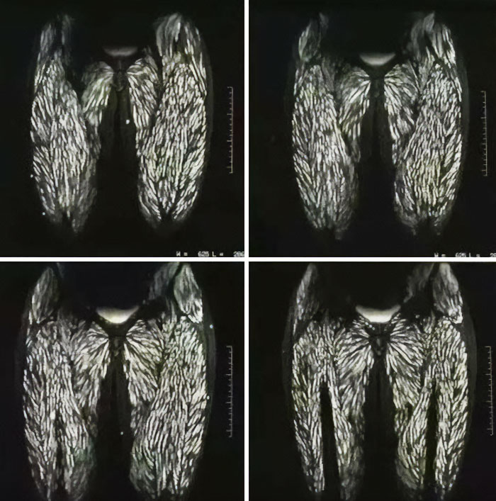 Parásitos en un chico que ha pasado 10 años comiendo carne cruda de cerdo