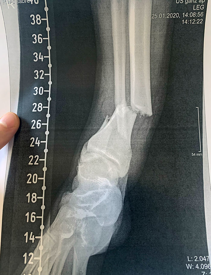 I Stepped On A LEGO Block And Broke My Ankle