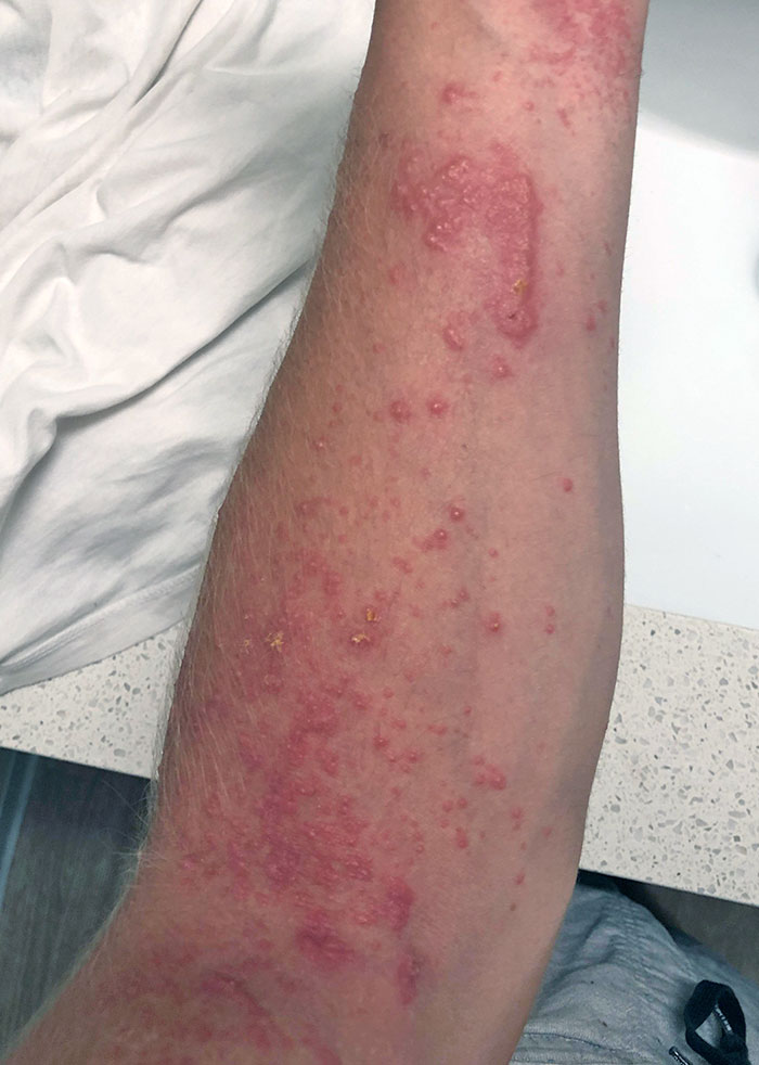 I Had A Feeling This Would Happen When I Saw The Poison Ivy Halfway Through The Job