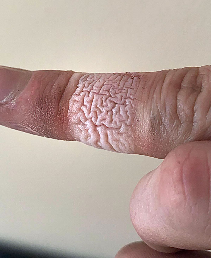 These Wrinkles On My Finger After I Removed A Bandaid
