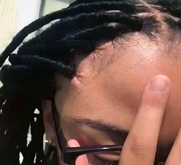 Getting Braids Done Too Tightly