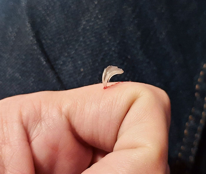 My Cat Just Scratched Me, And The External Layer Of Her Nail Was Left In