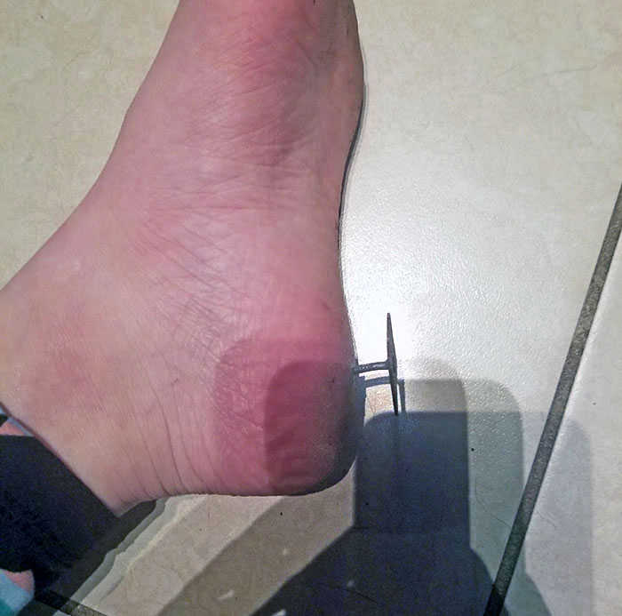 My Cat Got Out, And I Tried To Bring Him Inside, But Instead I Stepped On A Nail. Fun Times