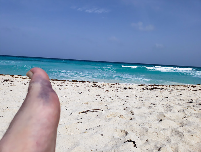I Broke My Foot In Cancun On The First Day Of My Honeymoon