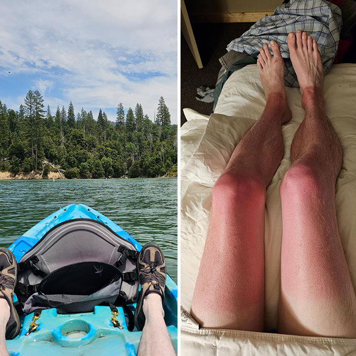 I Forgot To Put Sunblock On My Legs During A Kayak Trip On The Lake