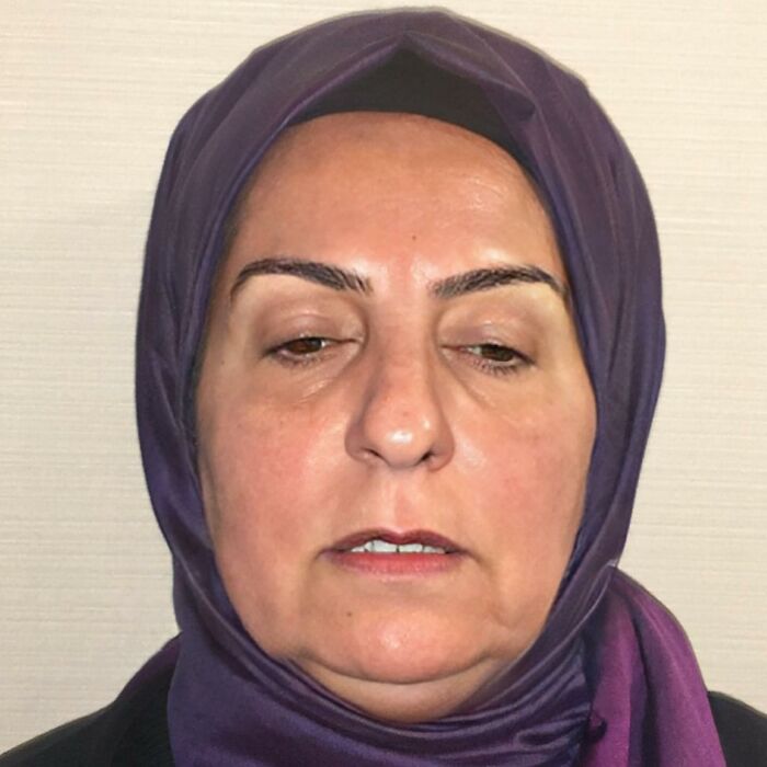 Before And After Photos From Turkish Plastic Surgery Clinic Have Left People Baffled Before And After Photos From Turkish Plastic Surgery Clinic Have Left People Baffled