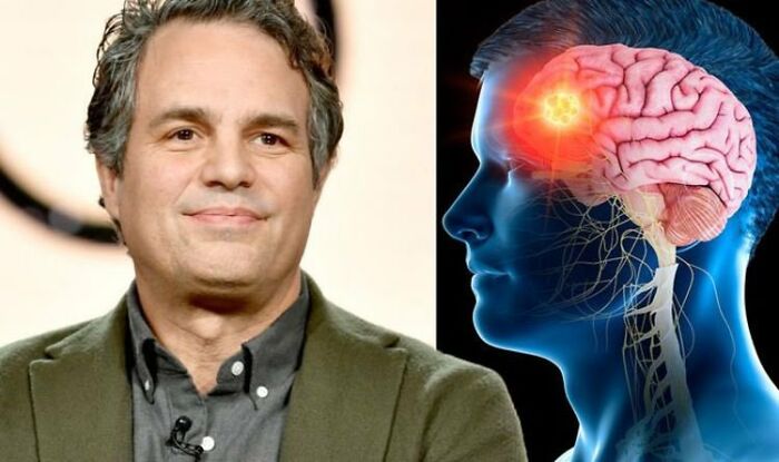 In 2001, Actor Mark Ruffalo Had A Realistic Dream That He Had A Brain Tumour