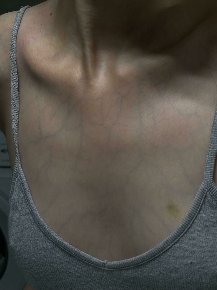 My Skin Is Translucent