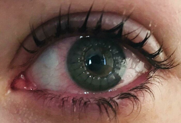 My Eye With Stitches After Full Thickness Cornea Transplant