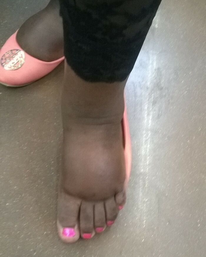 My Fiance, Normally A Lean Machine, Has Experienced A Lot Of Swelling During Pregnancy. Here's Her Foot