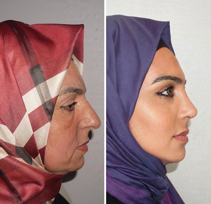 Before And After Photos From Turkish Plastic Surgery Clinic Have Left People Baffled Before And After Photos From Turkish Plastic Surgery Clinic Have Left People Baffled
