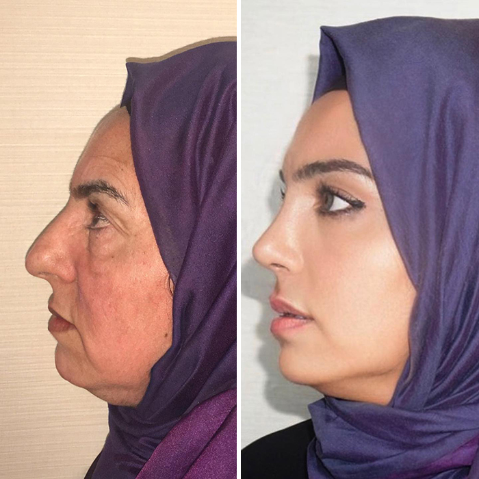 Before And After Photos From Turkish Plastic Surgery Clinic Have Left People Baffled Before And After Photos From Turkish Plastic Surgery Clinic Have Left People Baffled