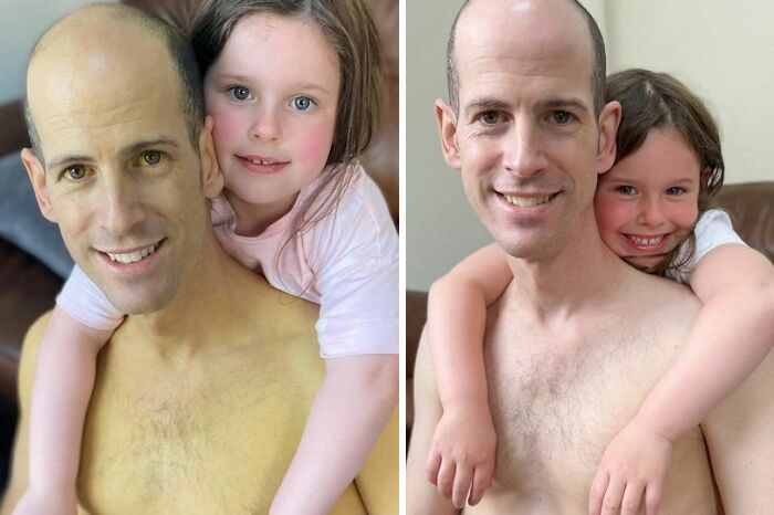 Man Shares Picture Before And After A Liver Transplant