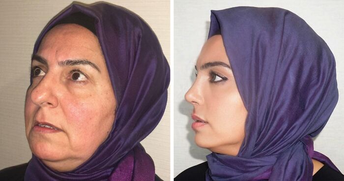 Before And After Photos From Turkish Plastic Surgery Clinic Have Left People Baffled