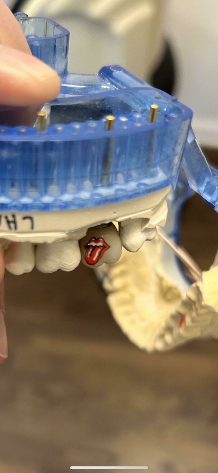 One Of My Patients Asked For A Rollings Stones Logo On Their Crown So We Painted This For Them