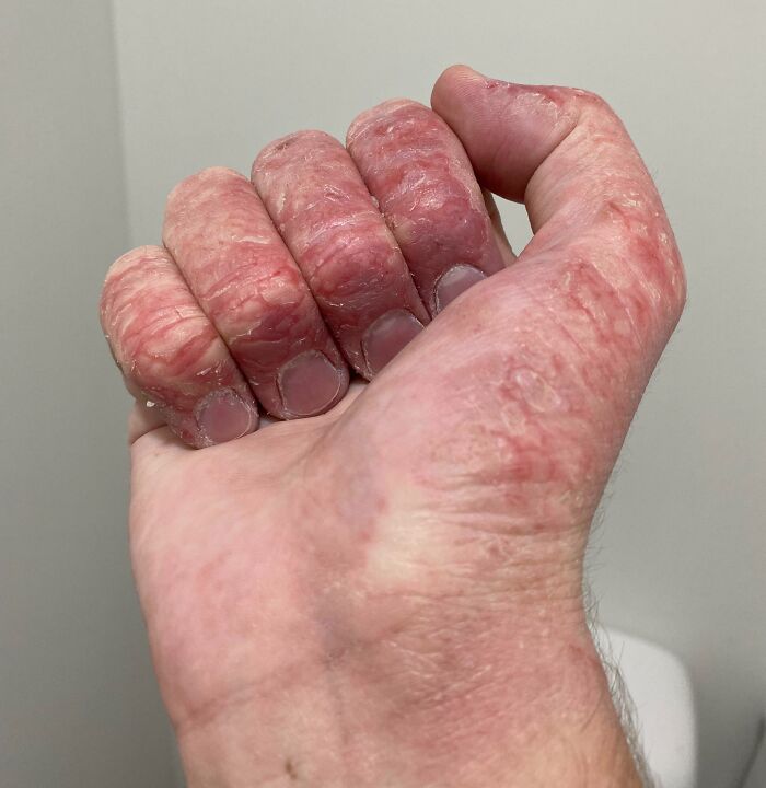 He tenido que estar de baja 2 semanas porque al parecer soy alérgico a algo de mi trabajo