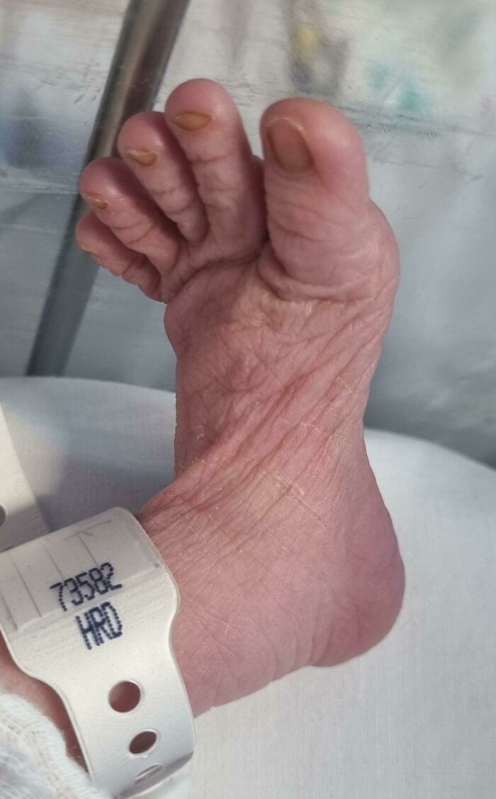 My Daughter Was Born With Hobbit Feet