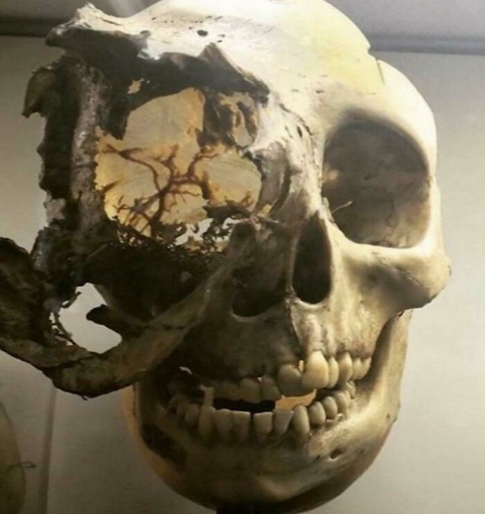 Skeletal Cancer Aftermath