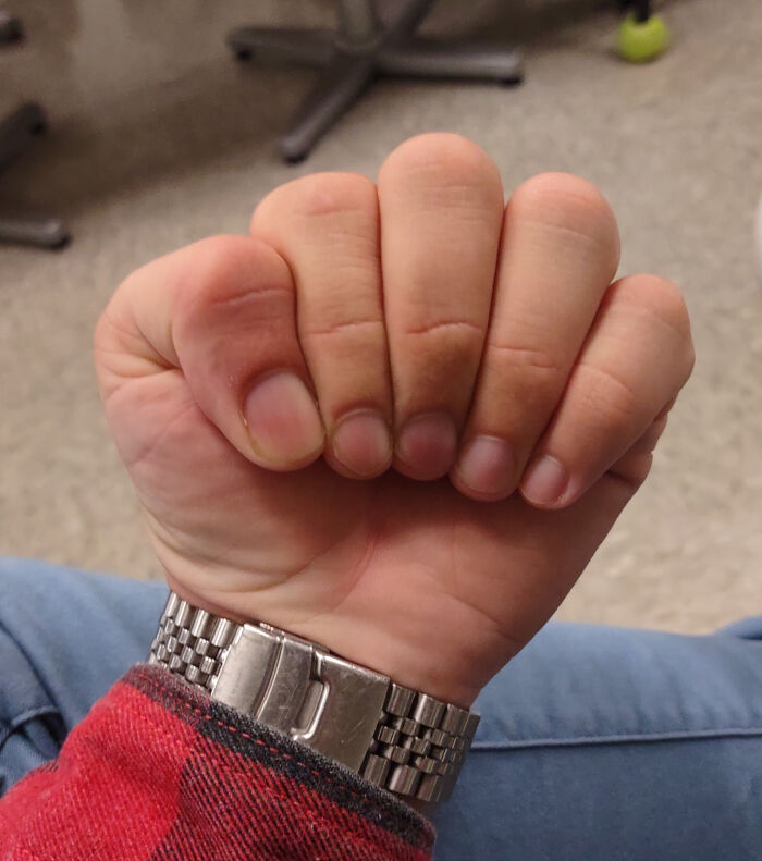 Hypermobile Thumbs Allow Me To Make Them Non-Opposable If I Want