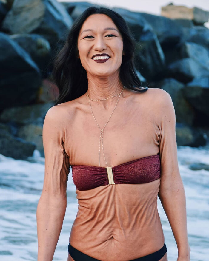 Ehlers-Danlos Syndrome