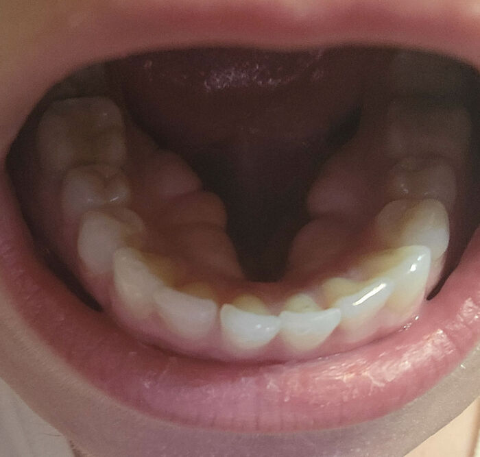 I've Got Too Many Bones In My Mouth