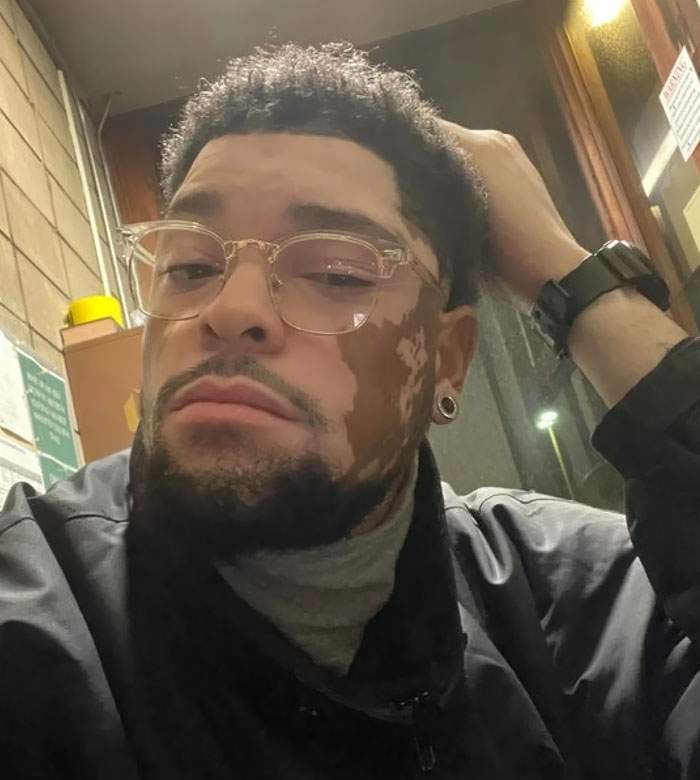 Vitiligo Appreciation Post. Took Me 28 Years To Realize That I’m Blessed