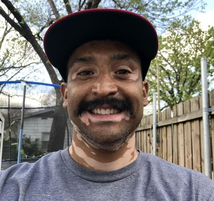 Embrace What You Got. At 40 Years Of Age I Was Diagnosed With Vitiligo. Never Be Ashamed Or Embarrassed (I Know Easier Said Than Done) 