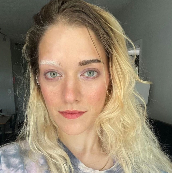 My Vitiligo Eyebrows