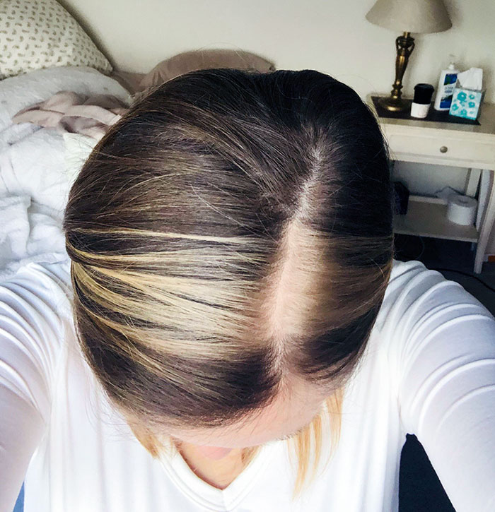 I've Had My "White Streak" Since I Was Born. Apparently Mine Is Genetic. My Great-Grandfather Was Also Missing Pigment In His Hair And Other Random Spots Down The Left Side Of His Body