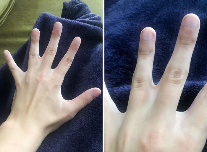 Anybody Else Webbed?