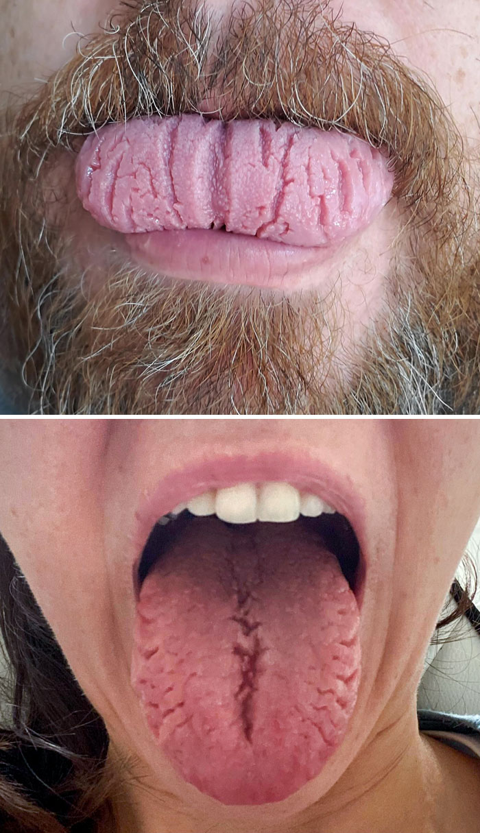 This Is My Tongue. I Have A Condition Called "Fissured Tongue". It Doesn't Hurt, But Just Looks Weird
