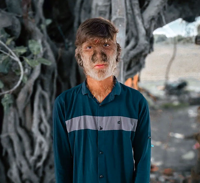 A Teenager From India Has A Rare Condition Called "Werewolf Syndrome", Or Also Known As Hypertrichosis