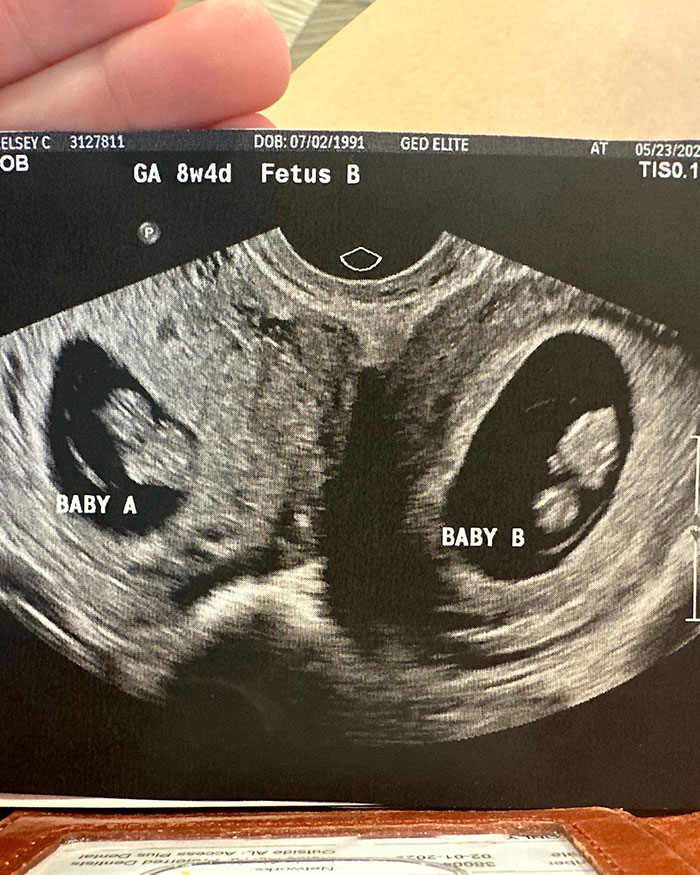Woman With Double Uterus Is Expecting A Baby In Both, Twin Daughters Could Be Born Weeks Apart Woman With Double Uterus Is Expecting A Baby In Both, Twin Daughters Could Be Born Weeks Apart
