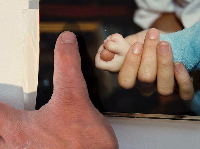 I Was Born With A Double Thumb But It Was Surgically Removed
