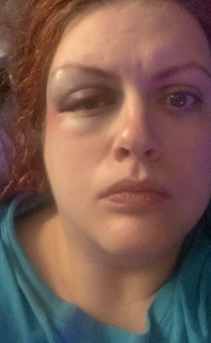 I Fell Off The Toilet Last Night Thanks To A Bad Leg Spasm. I Have A Concussion And Had A Minor Brain Bleed. My Son Starts School In Two Days And I Have To Take For His First Day