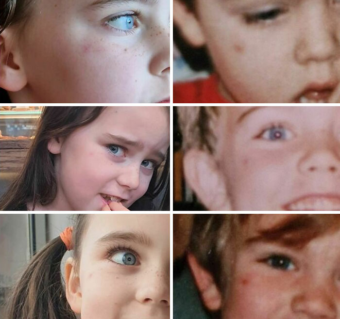 My Daughter Has Had A Red Mark On Her Cheek For Years, In The Exact Same Spot I Had A Red Mark On My Cheek For Years As A Child