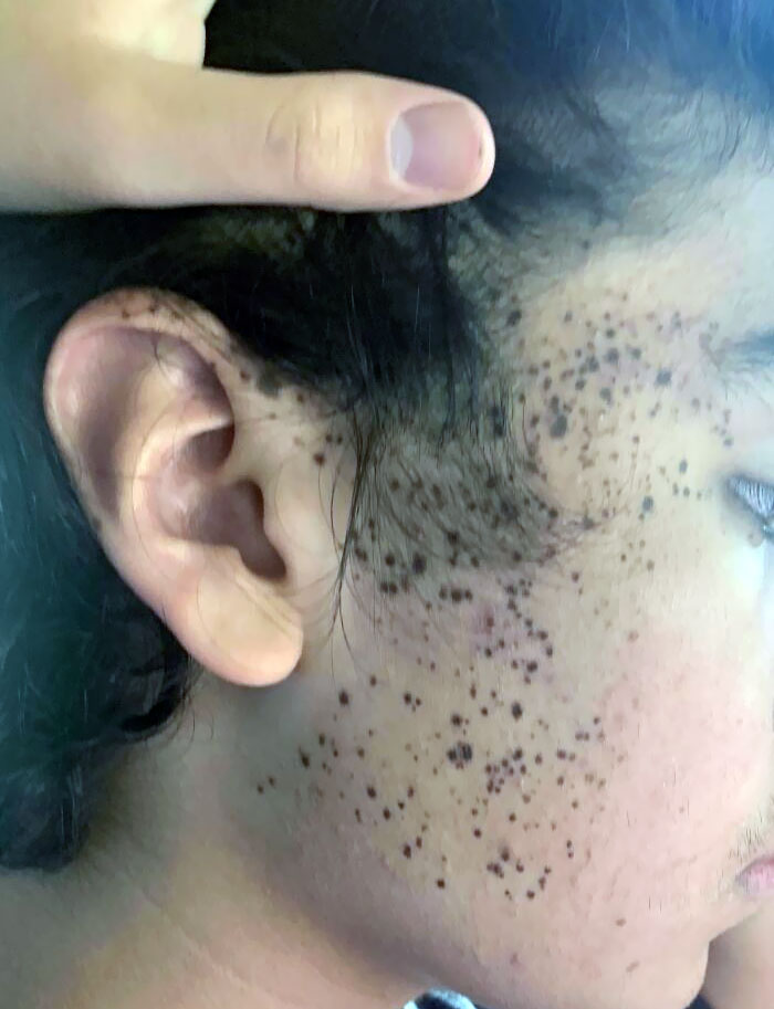 I Have A Lot Of Freckles Bunched Up On Just One Side Of My Face