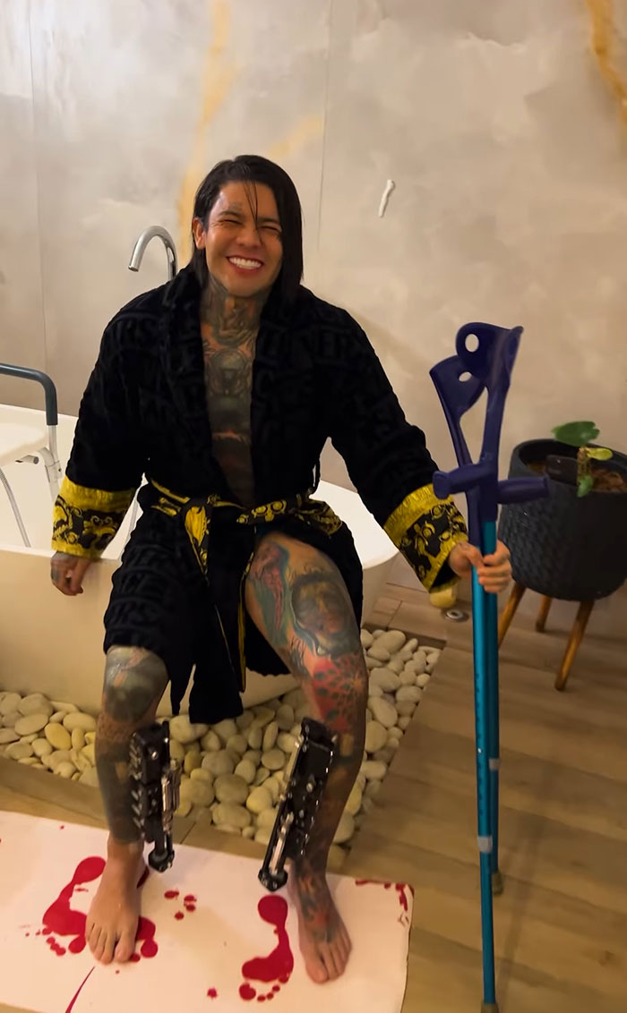 Influencer Spends $175,000 On &ldquo;Most Painful&rdquo; Leg-Lengthening Surgery To Grow Six Inches