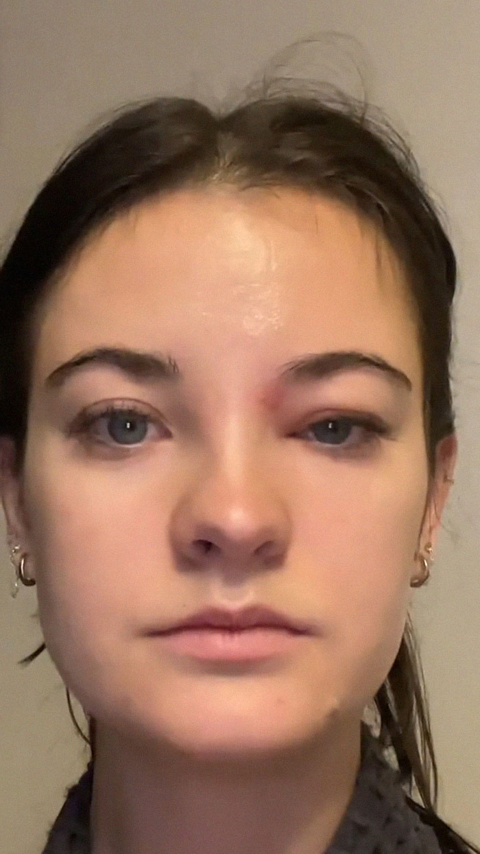 Fans Urge Brooke Hyland To Seek Medical Care After Showing Her “Triangle Of Death” Pimple Fans Urge Brooke Hyland To Seek Medical Care After Showing Her “Triangle Of Death” Pimple