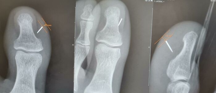 Great Start To The New Year. Stepped On A Sewing Needle Which Broke Off In My Big Toe