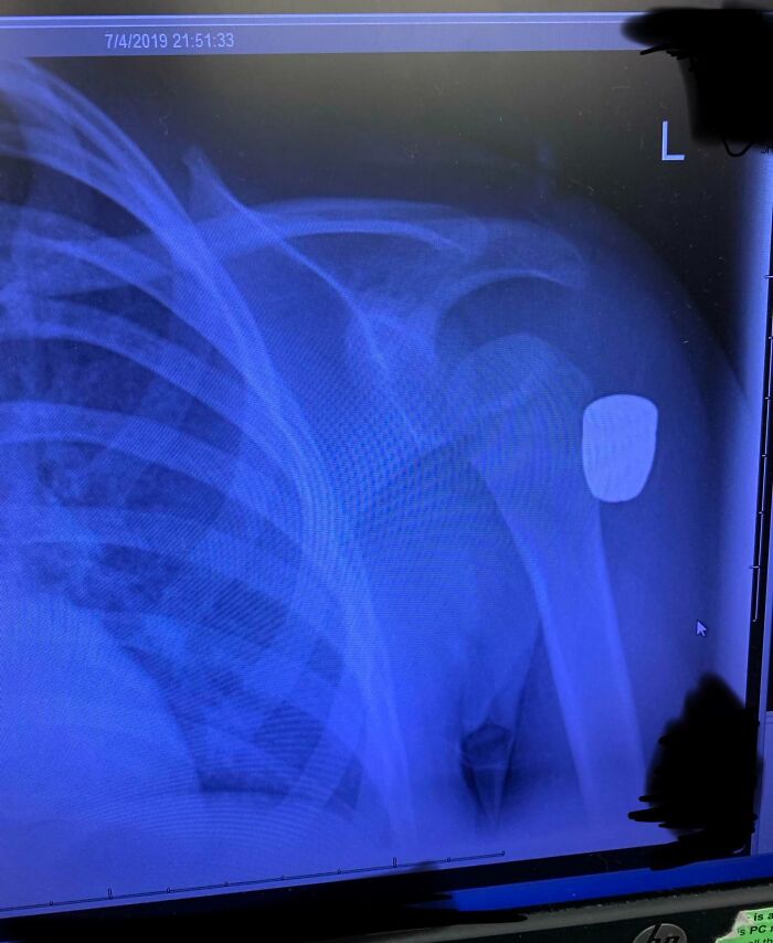 4-Year-Old Girl Hit In The Shoulder With A Falling Bullet While Enjoying Fireworks